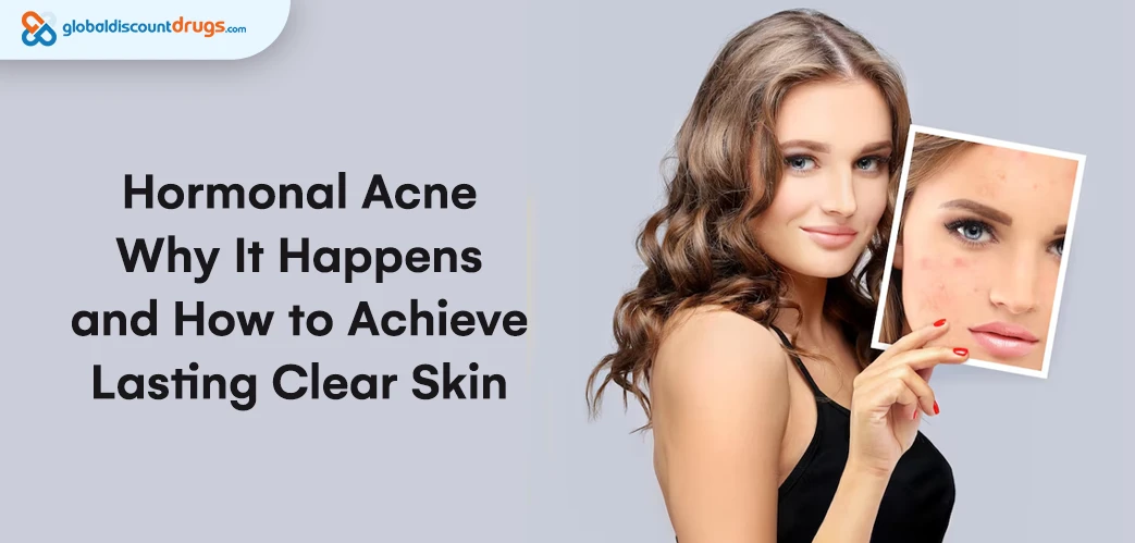 Hormonal Acne: Why It Happens and How to Achieve Lasting Clear skin
