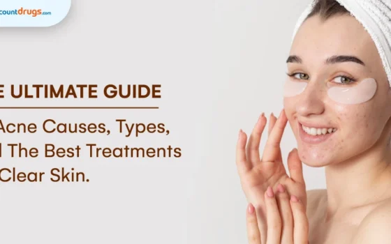 The Ultimate Guide to Acne