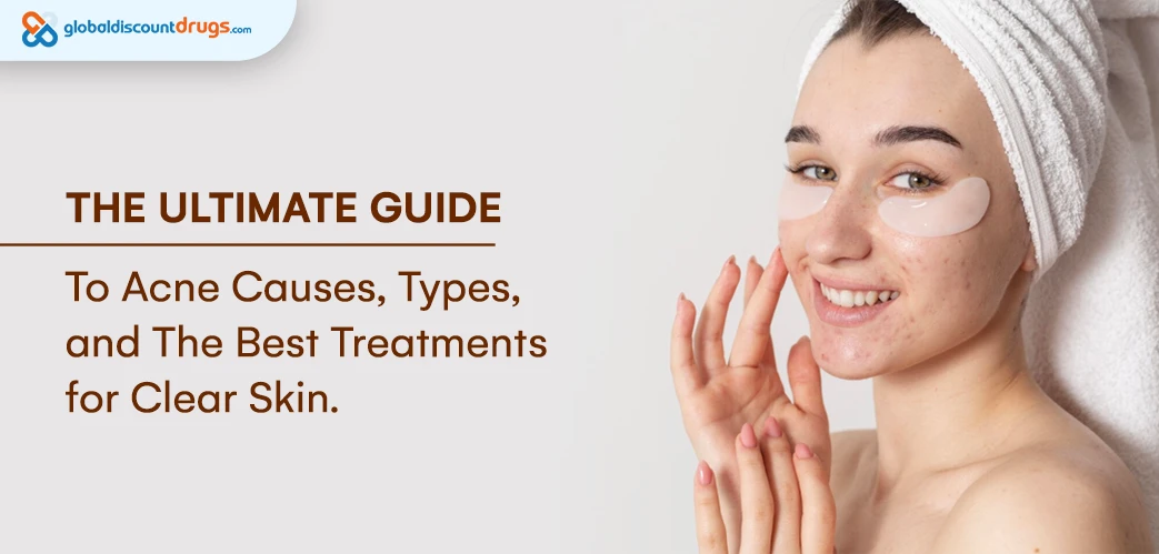 The Ultimate Guide to Acne