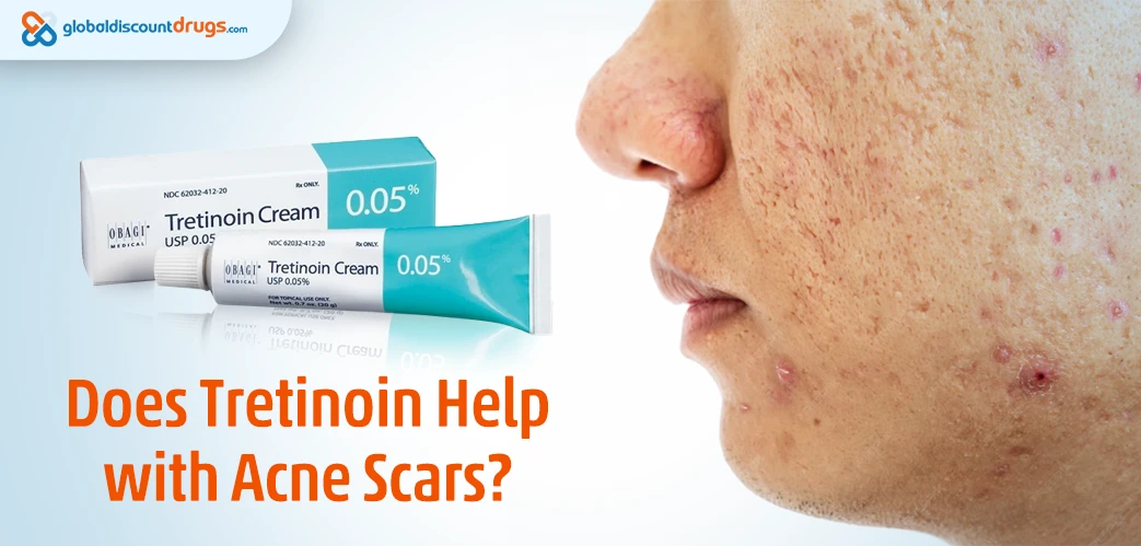 Does Tretinoin Help with Acne Scars