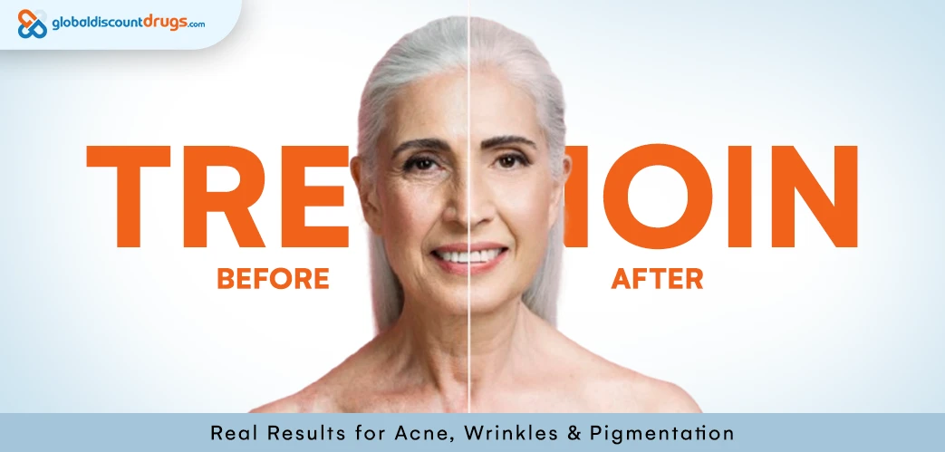 Tretinoin Before and After Real Results for Acne, Wrinkles & Pigmentation