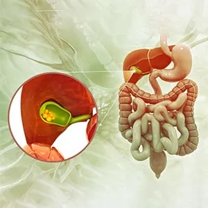 Gallstones