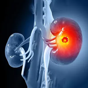 Kidney Cancer