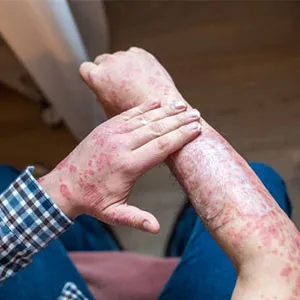 Psoriasis