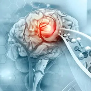 Stroke Due to Blood Clot in Brain