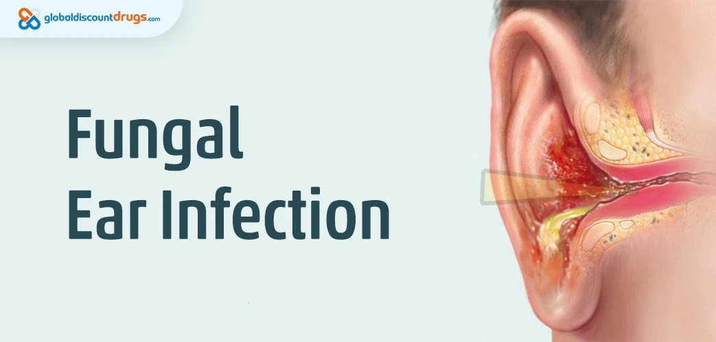 Fungal Ear Infection
