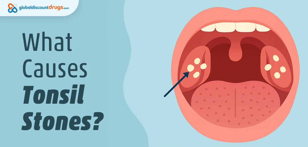 What Causes Tonsil Stones