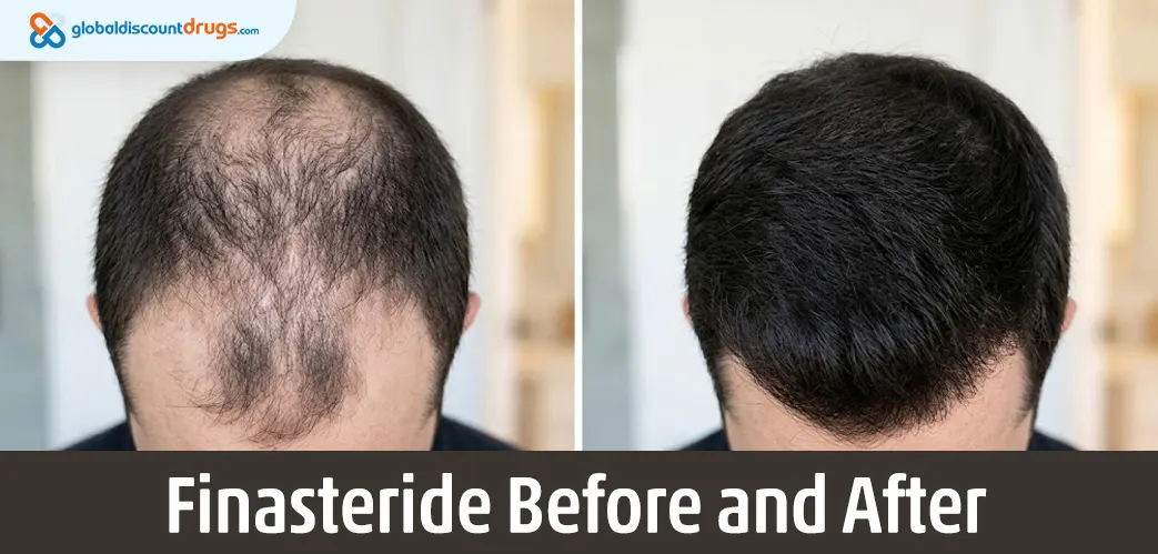 finasteride before and after