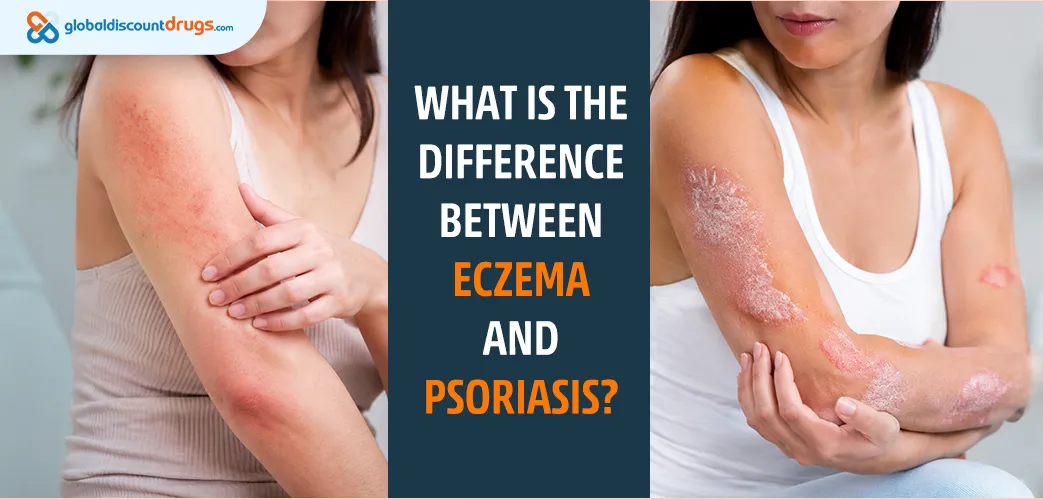 What Is The Difference Between Eczema And Psoriasis